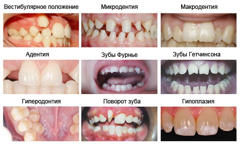 Циркониевые коронки на зубы: цены и особенности установки